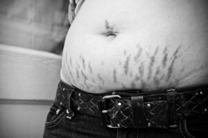 When will my stretch marks fade? 10 interesting facts you may not know