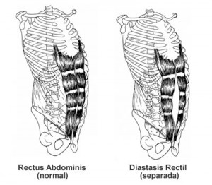 Muscle Separation Post Pregnancy