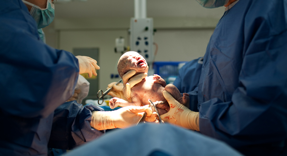 Baby being born via Caesarean Section