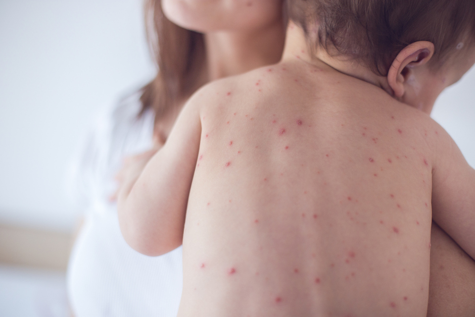 Parents urged to watch children for measles symptoms after following school student diagnosis