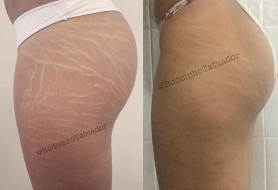 Henry The Hoover Tattoo Bad For Man's Love Life - Mandatory Stretch Mark Tattoo Camouflage Near Me - Online Colleges All