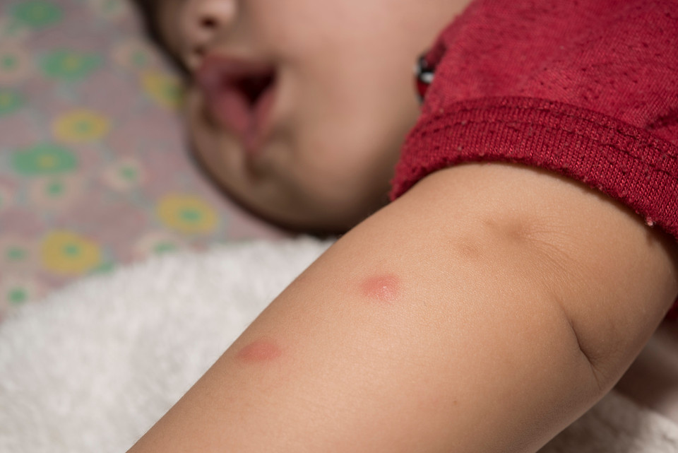 child insect mosquito bite