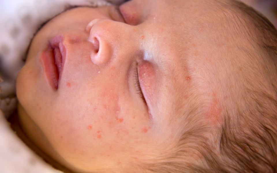 newborn red eyes