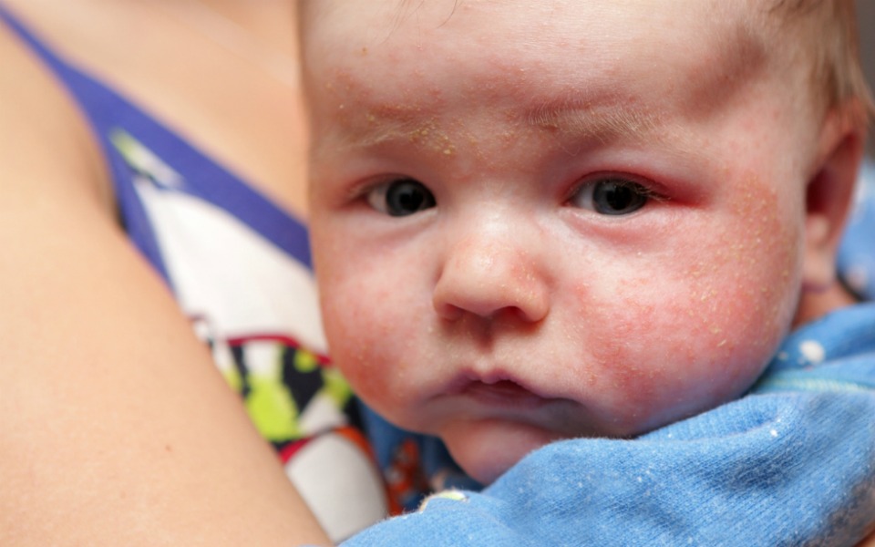 14 Newborn Rashes You Need To Know About