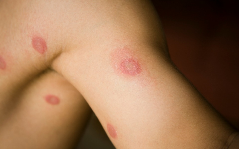 newborn rashes ringworm