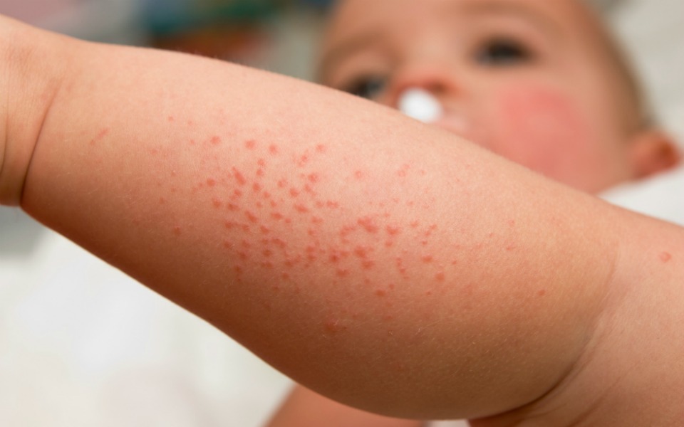 newborn rashes