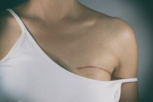 Breast Cancer To Be Most Common Type Diagnosed In 2017