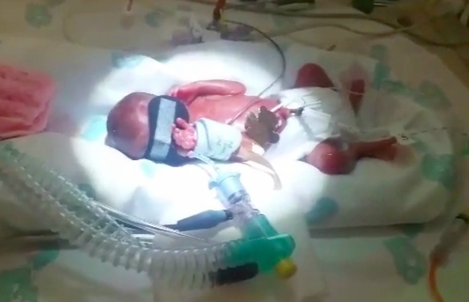 Baby born at 23 weeks proved doctors wrong Preamature Maebh NICU