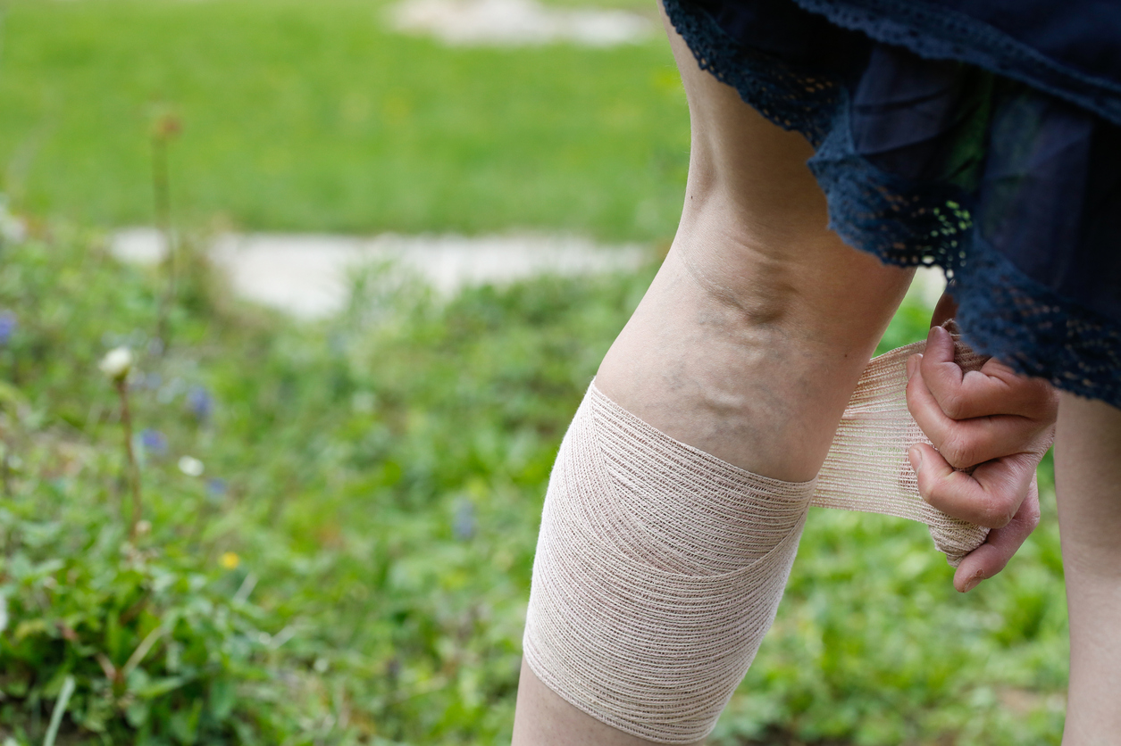 Woman with painful varicose and spider veins on her legs, applying compression bandage, self-helping herself. Vascular disease, varicose veins problems, painful unaesthetic medical condition concept.