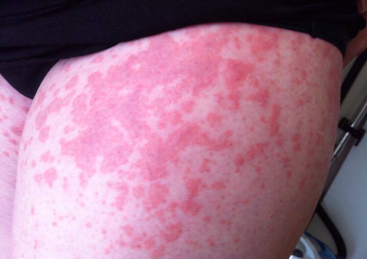 Pregnant Mums Rash Covered Her Whole Body ‘the Pain And The Itch Was