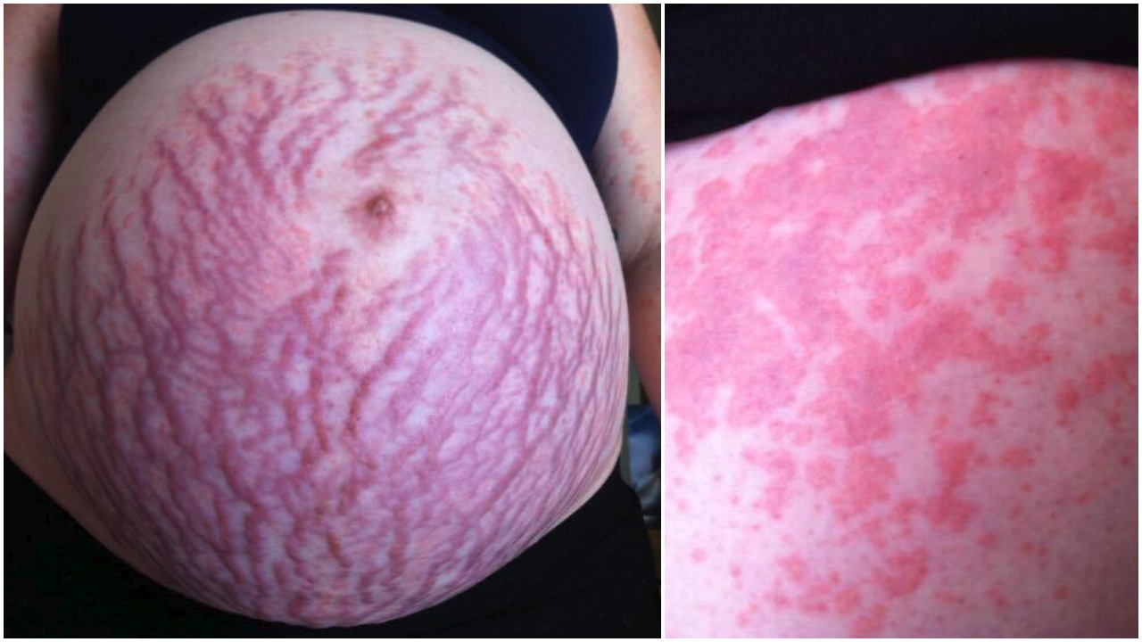 Pregnant mum's rash covered her whole body: 'The pain and the itch ... Pregnant mum's rash covered her whole body: 'The pain and the itch ...