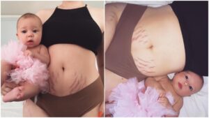 New mum shows off her stretch marks to celebrate postpartum bodies