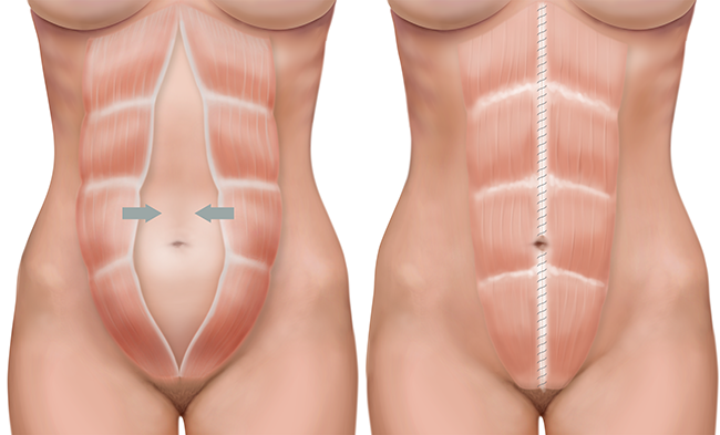 post pregnancy abdominal separation. Diastasis recti. 