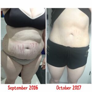 How this mum lost 35kgs and got rid of her stretch marks with NO surgery!