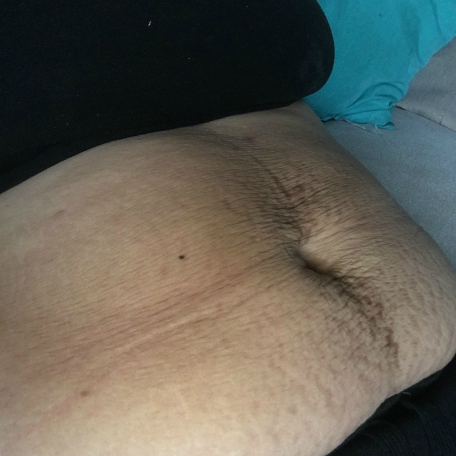 belly-saggy-skin