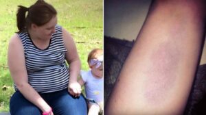 'Everyone thought I'd been in a fight': Mum explains why she was covered in bruises while pregnant