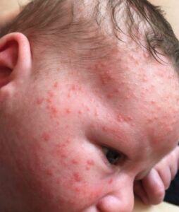 Common skin conditions your newborn may suffer with and how to treat it