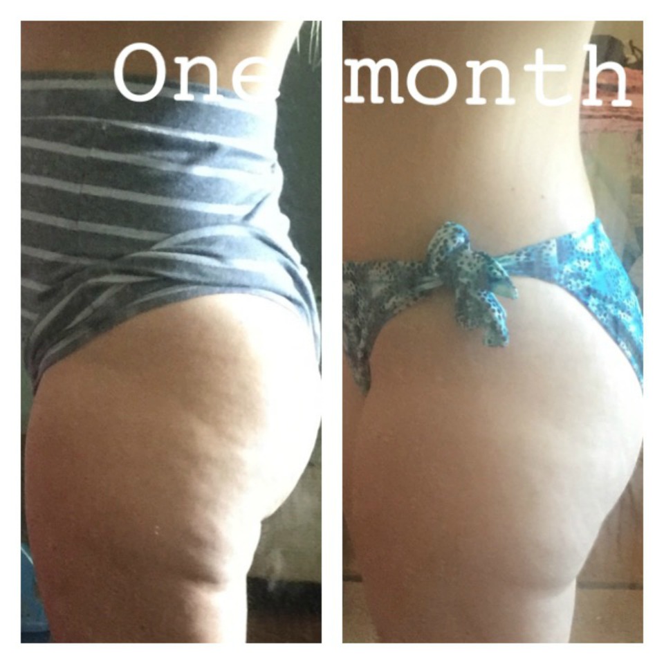 Gemma-Bath-Cellulite-Reduction-Bikini-Bottom-Results