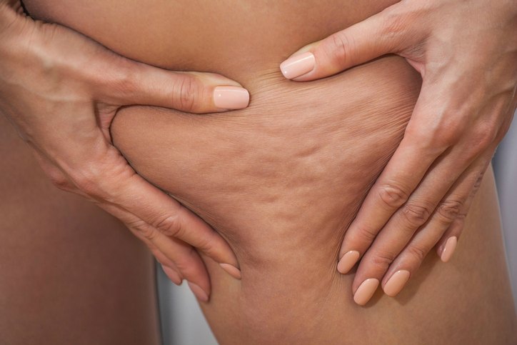 Healthy Mummy nutritionist reveals how to get rid of cellulite!