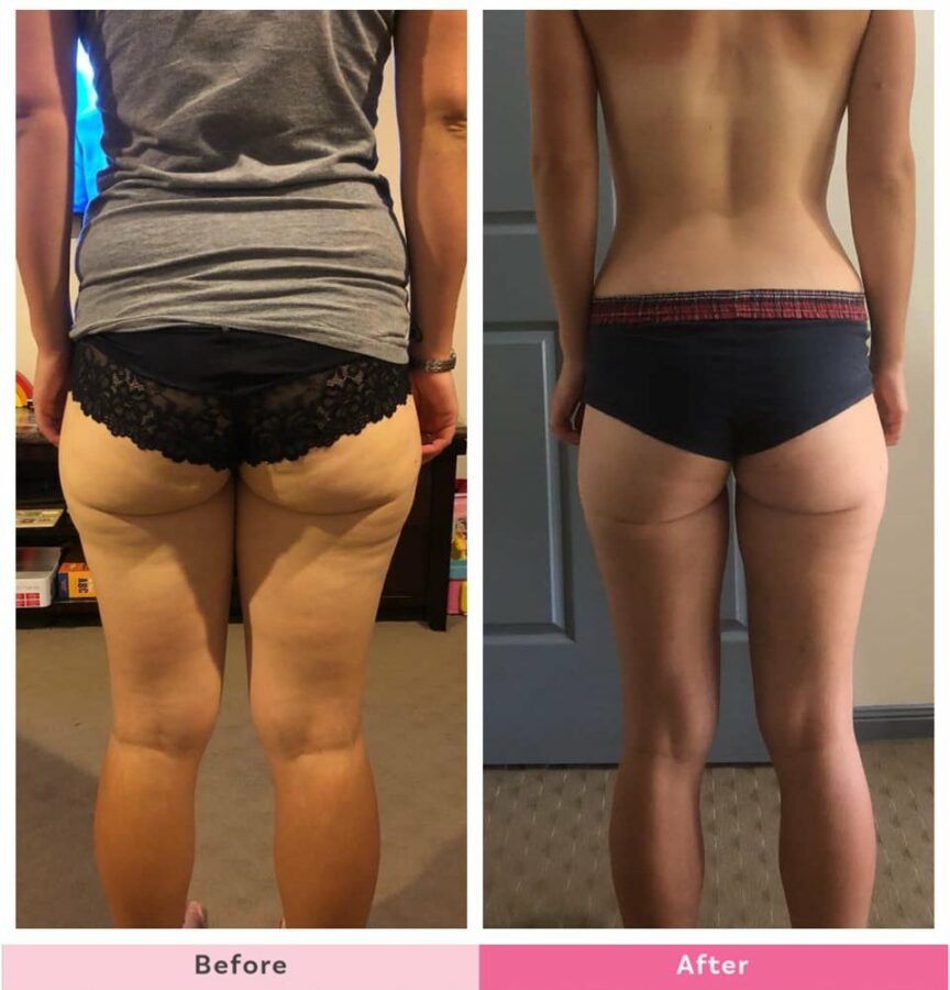 rebecca-harman-butt-transformation-before-after.001