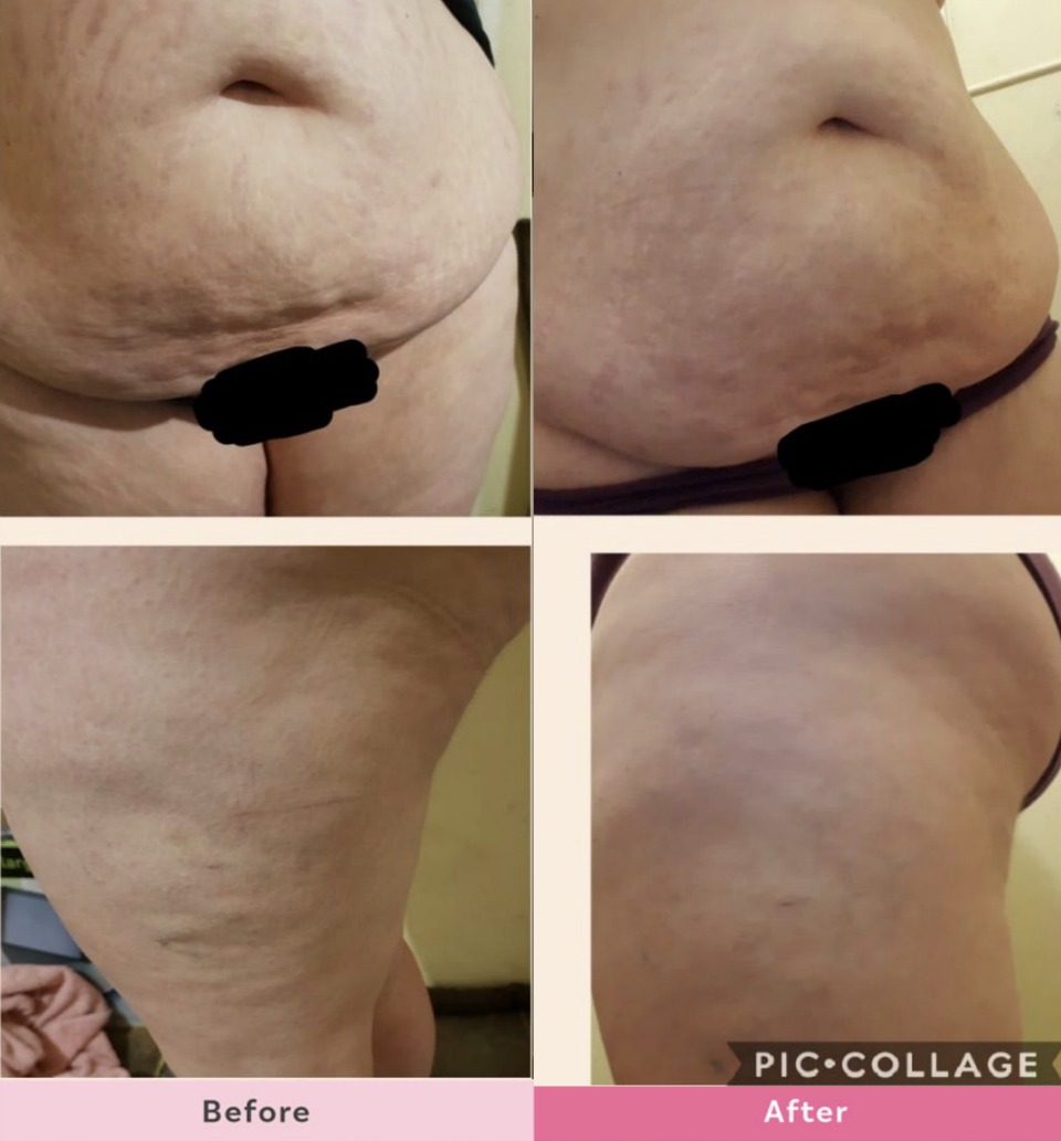 Anna-Smith-SKIN-body-sculpting-lotion-results-9days