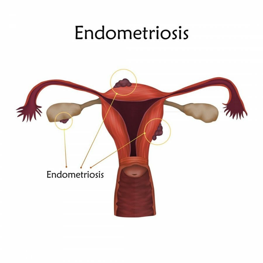 Endometriosis period pain