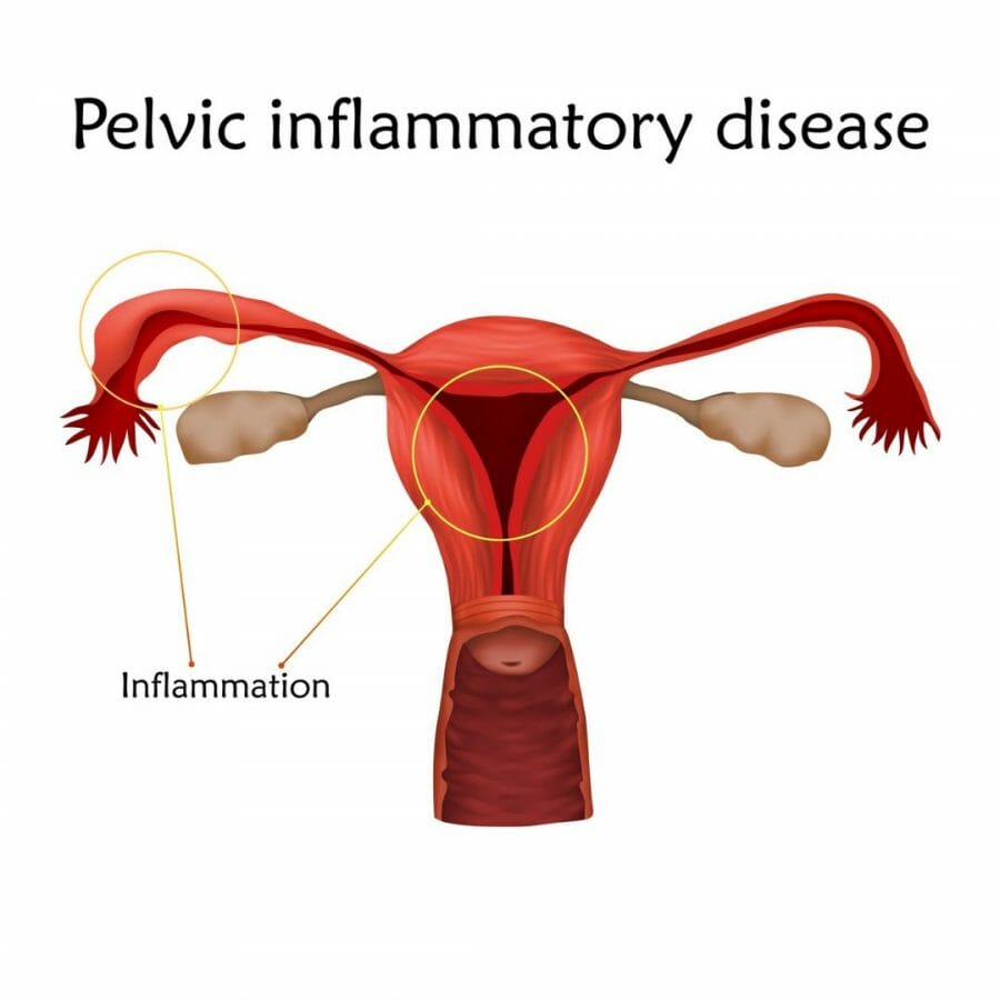 Pelvic inflammatory disease