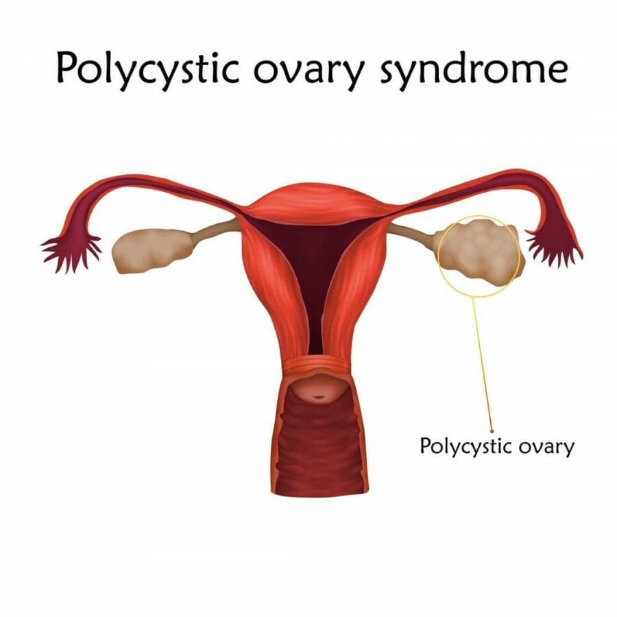period pain - Polycystic ovary syndrome PCOS