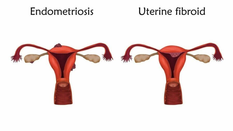Period pain - endometriosis vs fibroids